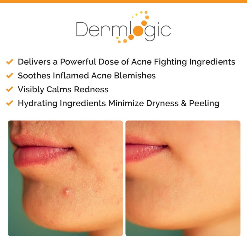 Dermlogic Acne Spot Treatment- Overnight Treatment for Whitehead & Blackhead Pimples. Eliminate Cystic Breakouts & Clogged Pores. Clears Away Severe, Mild, Moderate Blemishes for Teens & Adults. Alcohol-Free. - Image 2