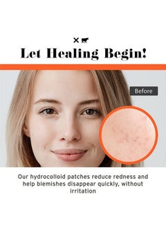 NO B. S. NO BAD STUFF No B.S. (No Bad Stuff) Healing Acne Patches with Hydrocolloid, Waterproof, Invisible Pimple Patches, Wear Under Makeup & Sunscreen, Acne Skin Care for Women & Men, Spot Patches for Pimples, 72 CT  - Image 5
