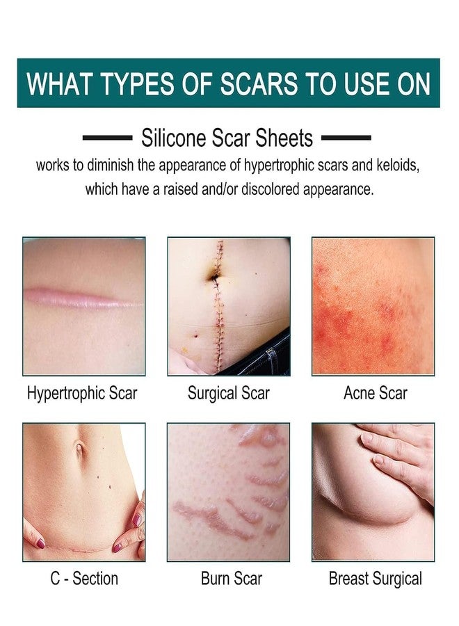 Jaimin Creation Scar Removal Silicon Tape Scar Removal Sheet Strips for C-Section, Acne Scars, Tummy Tuck, Keloid and Surgical Scars, Reusable Medical Grade Silicone Scar Tape, Get Scars Away Painless Reusable - Image 4