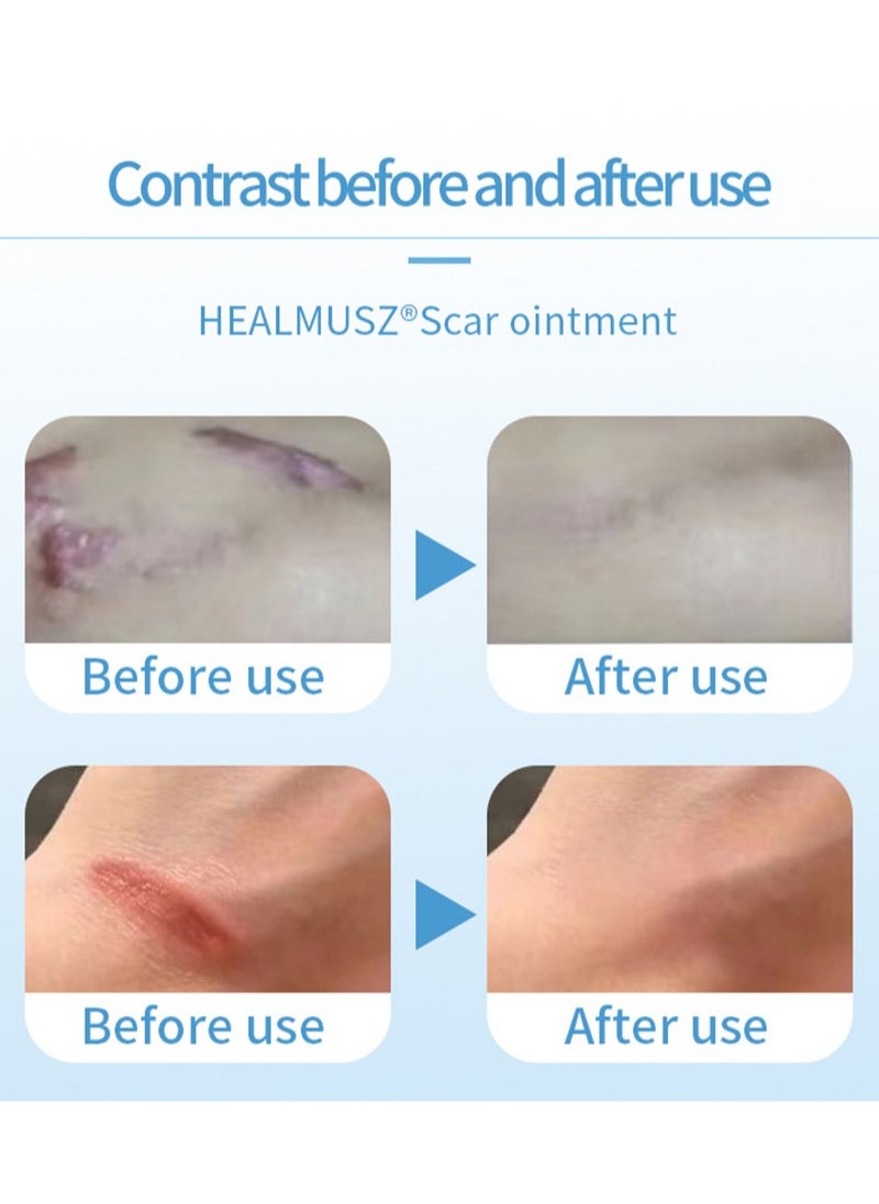 HEALMUSZ - Scar Treatment,Scar Cream,Lump Removal, Effective Scar Removal Cream for Acne Scars, Burn Scars, C-Section Scars, Stretch Marks and Surgical Scars - Image 1