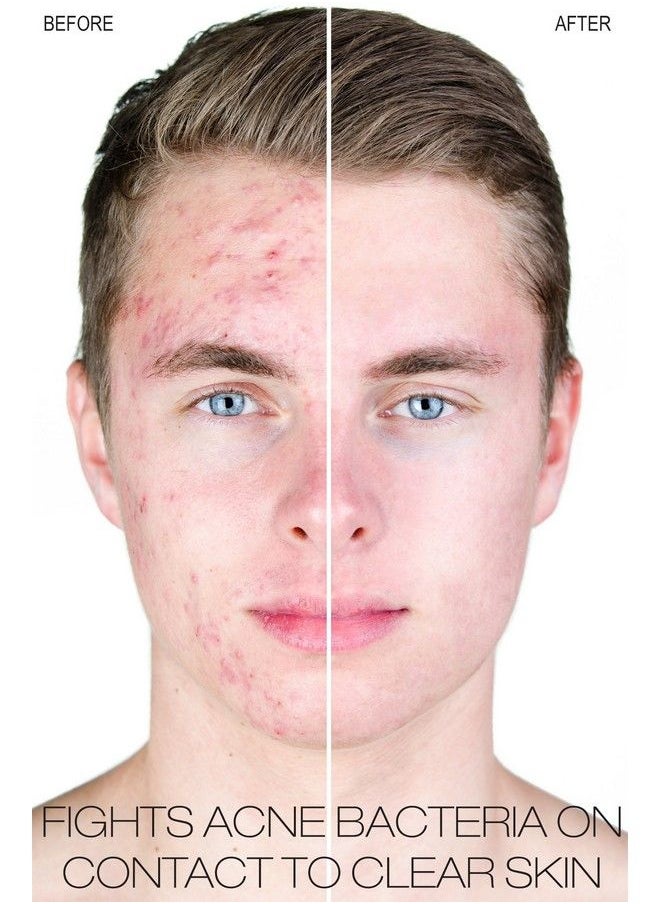 Beauty Facial Extreme - Benzoyl Peroxide 10% Severe Acne Cleanser Clinically Proven Wash To Fight Acne Bacteria On Contact For Cystic Breakouts Oily Skin Clogged Pores Blackhead & Whitehead Pimples For Face & Body. - Image 1
