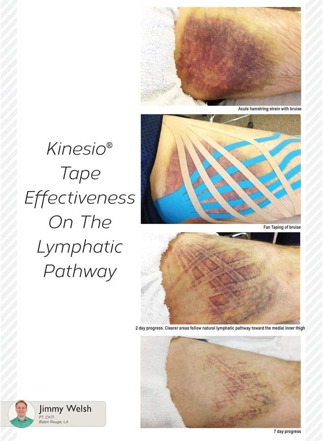 Kinesio Classic Fan Cut Edema Strips 12 Pack - Image 2