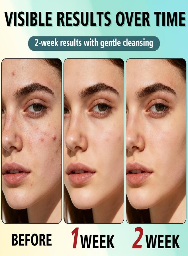 HORSEFISH TOOL Acne Treatment for Face, Acne Cream, Pimple Cream Suitable for All Skin, Blemish Care Cream for Face and Body, Gentle Daily Skin Care for Oily & Blemish-Prone Skin, Helps Improve Skin Appearance - Image 3