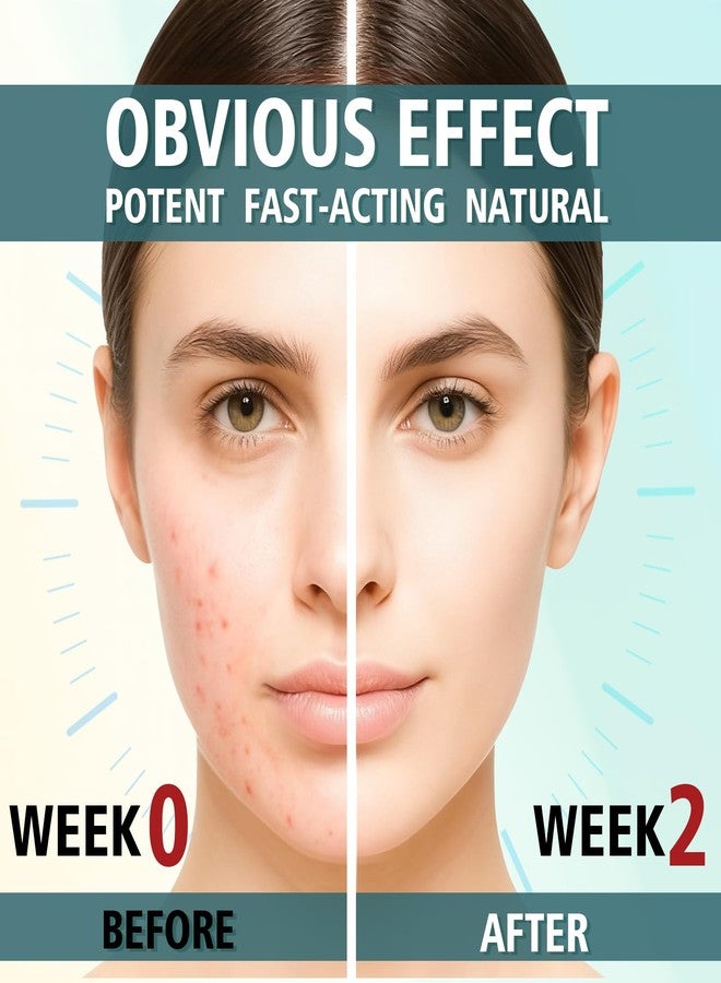 HORSEFISH TOOL Acne Treatment for Face, Acne Cream, Pimple Cream Suitable for All Skin, Blemish Care Cream for Face and Body, Gentle Daily Skin Care for Oily & Blemish-Prone Skin, Helps Improve Skin Appearance - Image 2