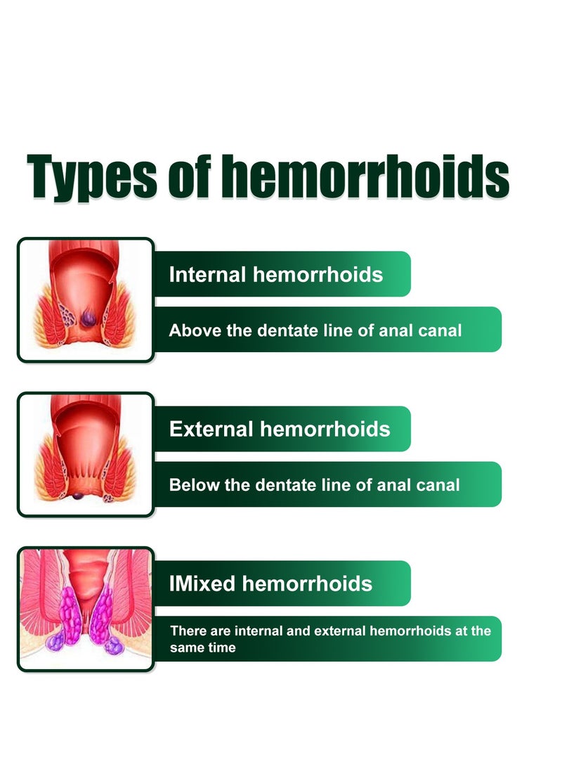 ساوث مون كريم علاج البواسير الداخلية والخارجية ، كريم البواسير العشبية ، كريم تخفيف البواسير العشبية ، رذاذ مهدئ شرجي ، مرهم شق البواسير (20 جم) - Image 4