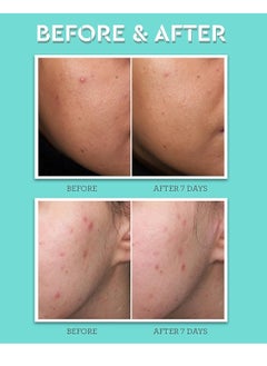BLISS Bliss Clear Genius Acne Spot Treatment – Maximum Strength 2% Salicylic Acid Shrinks Blemishes – Clean, Vegan, Cruelty-Free, 0.5 Fl Oz  - Image 5