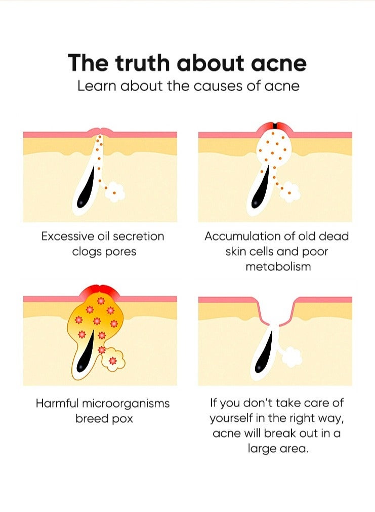 مويكا جل حمض الساليسيليك المضاد لحب الشباب 20 جم - Image 5