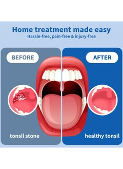 Ru syanl Tonsil Stone Removal Kit Tonsil Stone Remover Vacuum with Built-in Blue Light Rechargeable Tonsil Stone Remover for Bad Breath  - Image 4