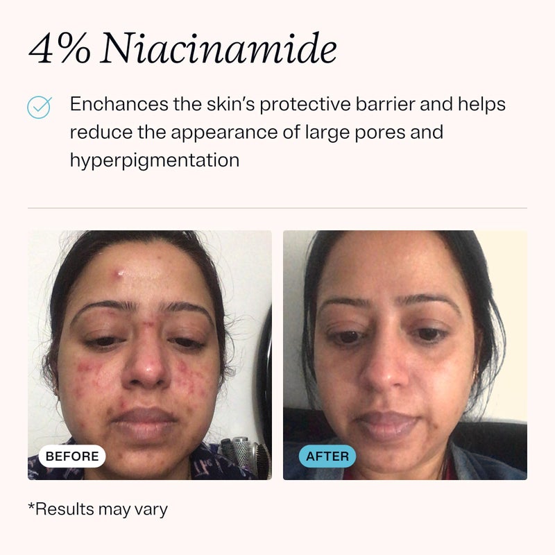 MDacne â€“ Retinol 0.5% and Niacinamide 4% Cream, Reduces Blemishes and Improves Skin Texture without Irritation - Image 4