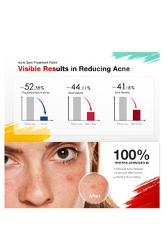 JOVS Jovs AcneBye Smart Acne Patch & Acne Mark Patch – Blue & Red Light Therapy, Salicylic Acid, Centella Asiatica, Fast Acne Removal, Fades Acne Scars, Hydrocolloid, Clinically Tested  - Image 3