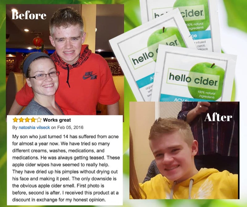 hello cider Apple Cider Vinegar Acne Face Wipes-Organic TeaTree, Rose, Chamomile, Witch Hazel.Oil free. Reduce Blemish & Acne. Tone,Restore, Sooth, Balance pH. Dry, Normal, Sensitive Skin. 25ct. USA Hello Cider - Image 5