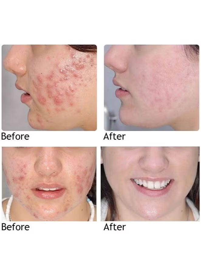 AuQuest Acne Remoyal Gure Gel -Herbal Acne Treatment Cream Pimple Spot Removal for Teens Oil Control Acne Scar Gel Shrink Pores Skin Care Beauty Health 20g - Image 5