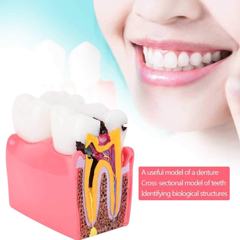 comfrt Dentist Teaching Model, Standard Teeth Model, Caries Comparison Study Models Dentist Dental Anatomy Education Teeth Model - Image 3