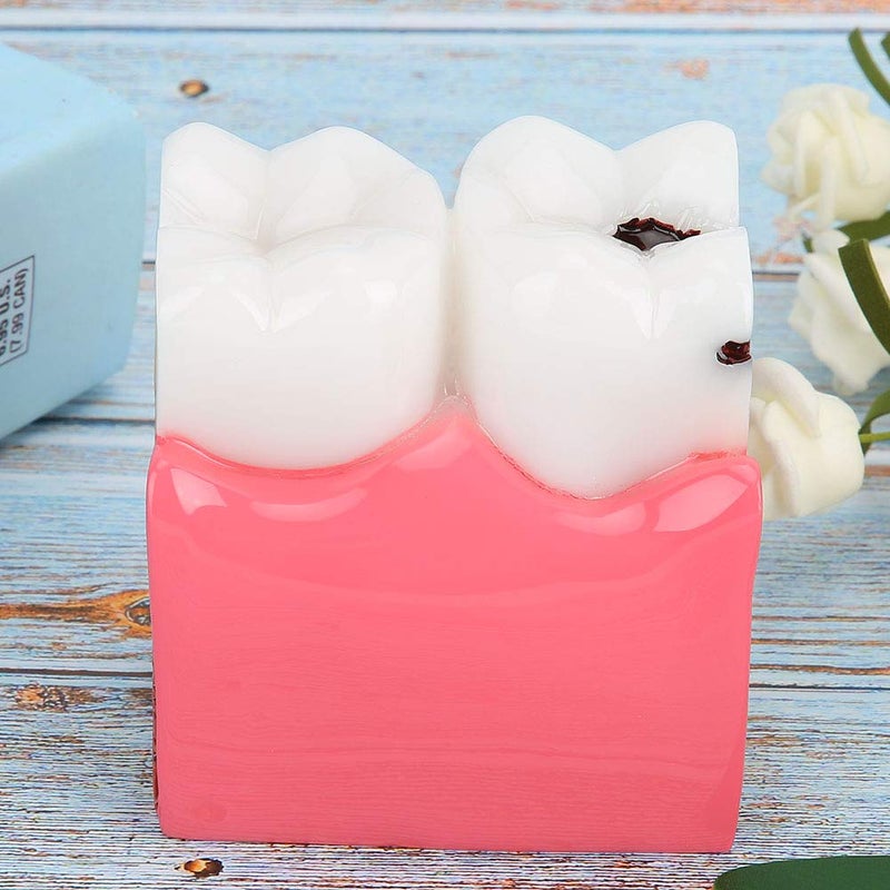 comfrt Dentist Teaching Model, Standard Teeth Model, Caries Comparison Study Models Dentist Dental Anatomy Education Teeth Model - Image 5