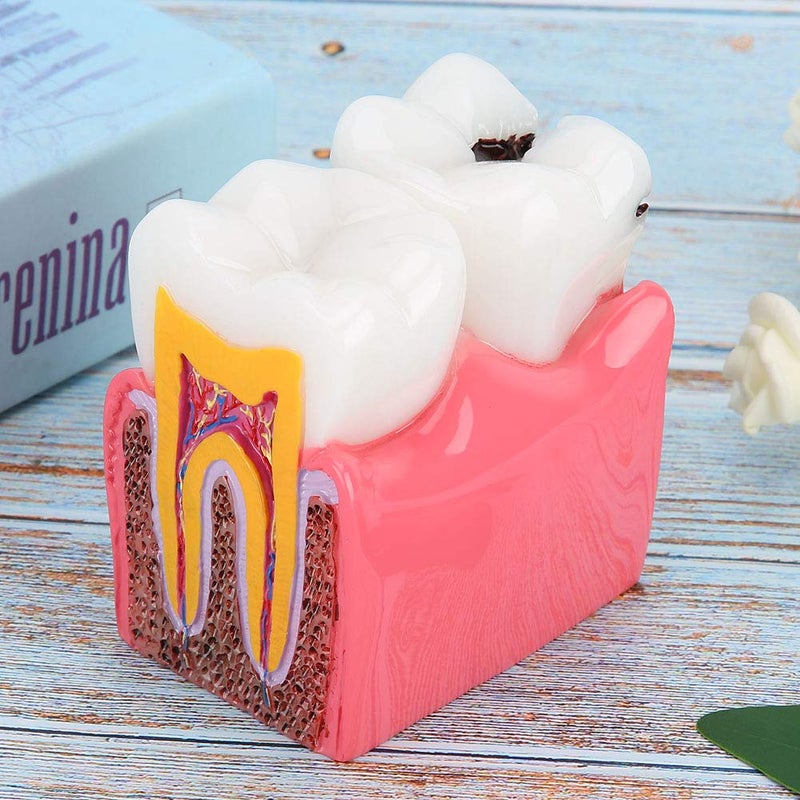 comfrt Dentist Teaching Model, Standard Teeth Model, Caries Comparison Study Models Dentist Dental Anatomy Education Teeth Model - Image 4