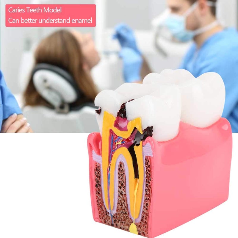 comfrt Dentist Teaching Model, Standard Teeth Model, Caries Comparison Study Models Dentist Dental Anatomy Education Teeth Model - Image 2