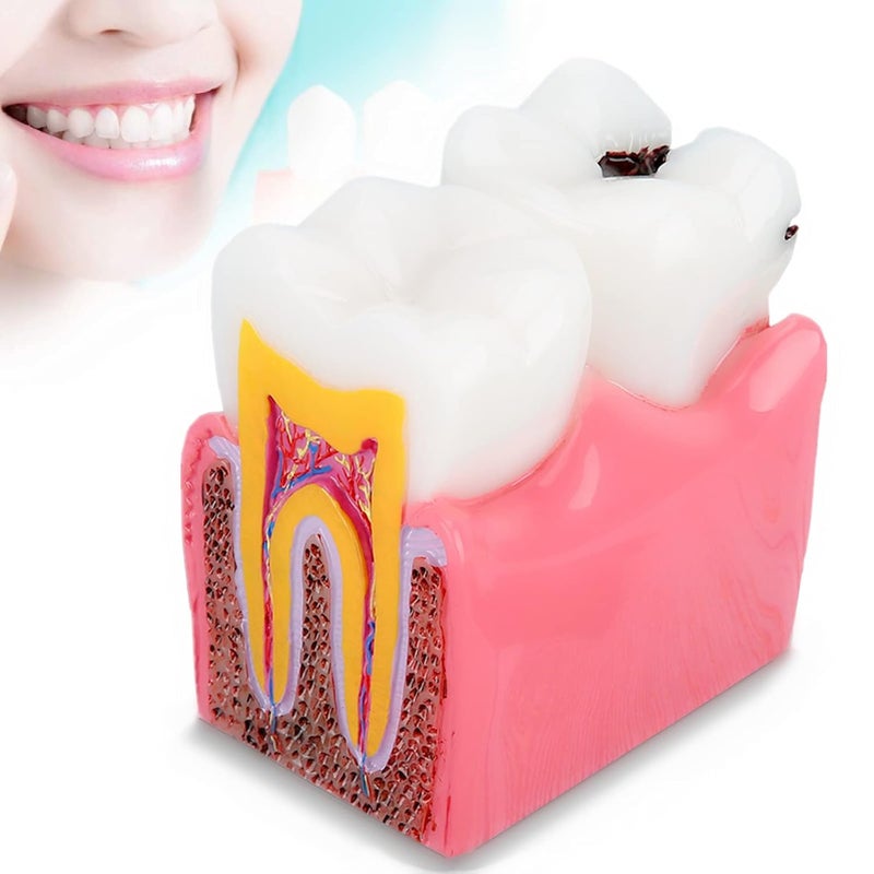 comfrt Dentist Teaching Model, Standard Teeth Model, Caries Comparison Study Models Dentist Dental Anatomy Education Teeth Model - Image 1