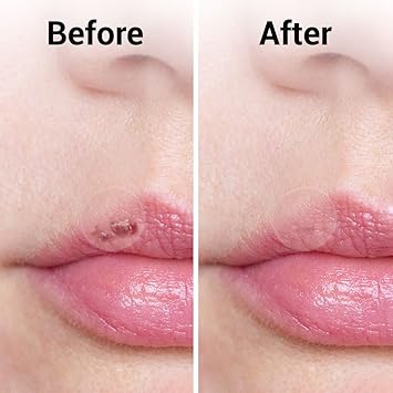 SOL لصقات SOL لعلاج البثور والقرح الباردة 36 حبة 12 قطعة 8 مم 24 قطعة 12 مم للعناية بالبشرة لصقات الهيدروكوليد لعلاج حب الشباب تقلل من التورم تهدئ البشرة تمنع الندوب شبه غير مرئية مثالية للاستخدام الليلي - Image 4