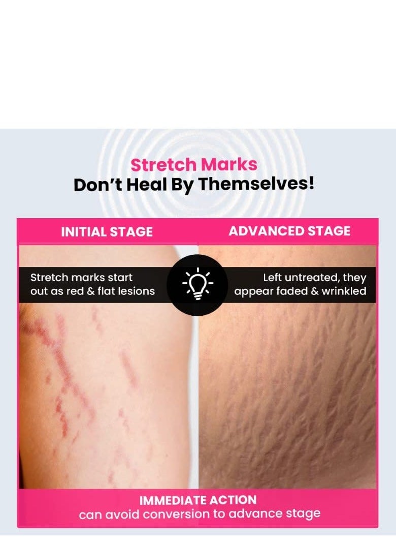 ThriveCo Stretch Marks Expert Serum Cream  For New red and Old white Stretch Marks Removal and Skin Hydration Powered by Striover™, Rosehip Oil and Squalane For Men and Women 30ml - Image 3