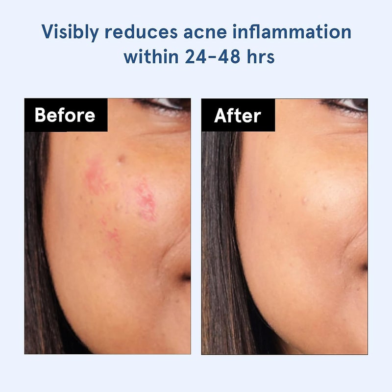 Bodywise لصقات حب الشباب للنساء من بي بودي وايز 48 نقطة 3 أحجام عبوة من 2 - Image 3