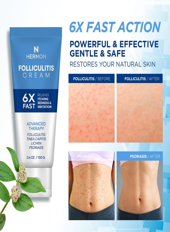 Hermon Folliculitis Cream: Effective for Folliculitis Scalp Face and Body 100g - Image 2