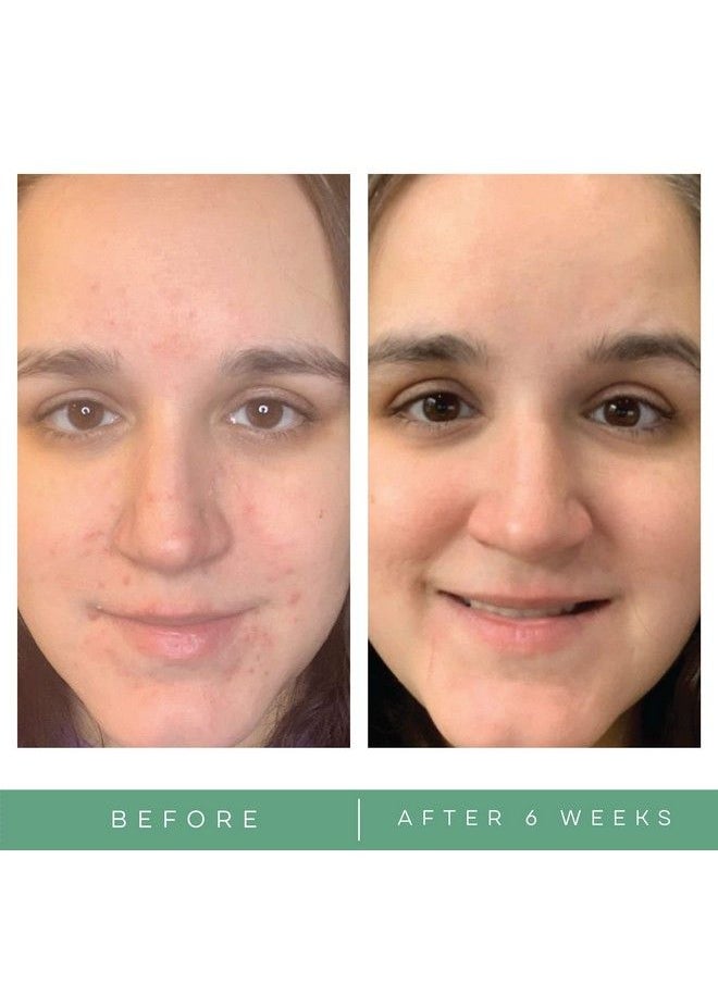 Replenix Benzoyl Peroxide Acne Gel 10% Spot Treatment  - Image 5