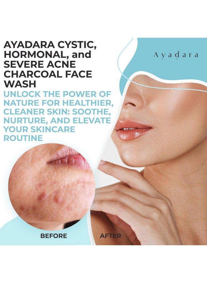 ايدارا غسول الوجه بالفحم لعلاج حب الشباب الشديد من أيادارا، 3.4 أونصة، غسول يومي للوجه بالكبريت والعسل، منظف للوجه بالفحم، غسول وجه للرجال لعلاج حب الشباب، غسول وجه عميق بالفحم للنساء والرجال، 200 استخدام - Image 2
