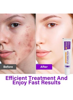 CARVENCHY Azelaic Acid Serum, Azelaic Acid 12% Cream，Hyaluronic Acid and Niacinamide, Relieves Redness, Dark Spots, Rosacea, Balances Excess Sebum, Brightening Face Skin Care Treatment for All Skin Types 20g  - Image 2
