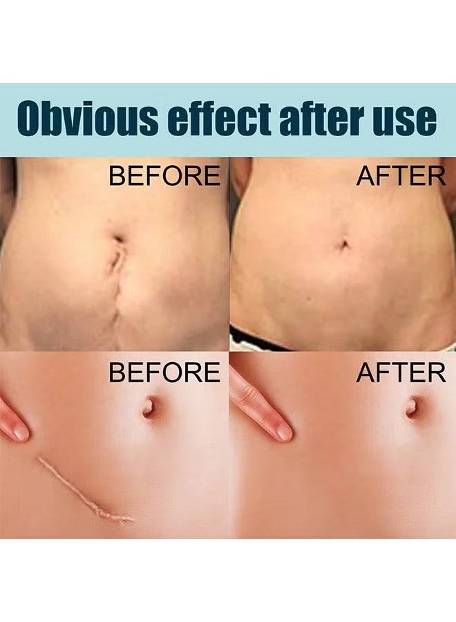 إيلهو جل الندبات المتقدم، جل طبي لإزالة الندبات، جل متقدم لإزالة الندبات الجراحية، علامات التمدد، حب الشباب، الإصابات، الحروق، الجدرة، الندبات القديمة والجديدة المتضخمة، 50 مل - Image 2