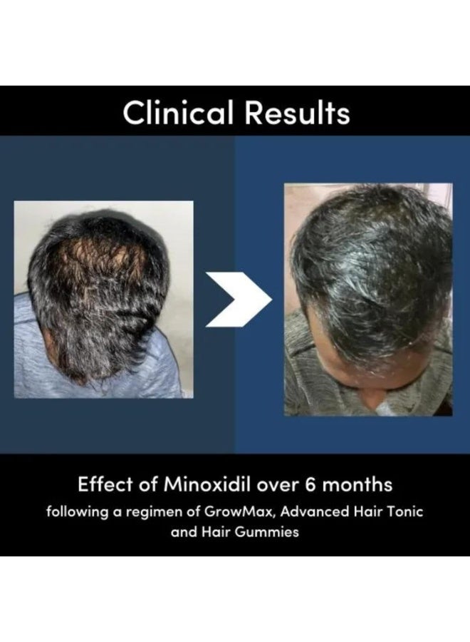 Man Matters Minoxidil for Men, 5% Hair Growth Serum Solution I Prevents Hair Loss, Thinning I Reactivate Hair Follicles & Hair Growth I Alcohol Free I Non-Sticky I Unscented I All hair Type I 60 ml - Image 4