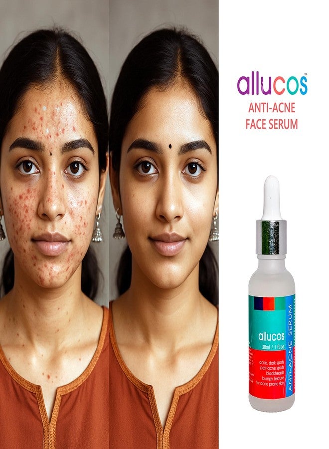 ALLUCOS Anti-Acne Serum | 100% Natural & Paraben-Free | Reduces Pimples, Blemishes & Acne Scars | Controls Oil & Soothes Skin | Suitable for All Skin Types - For Men & Women - 30ml (Pack of 1) - Image 2