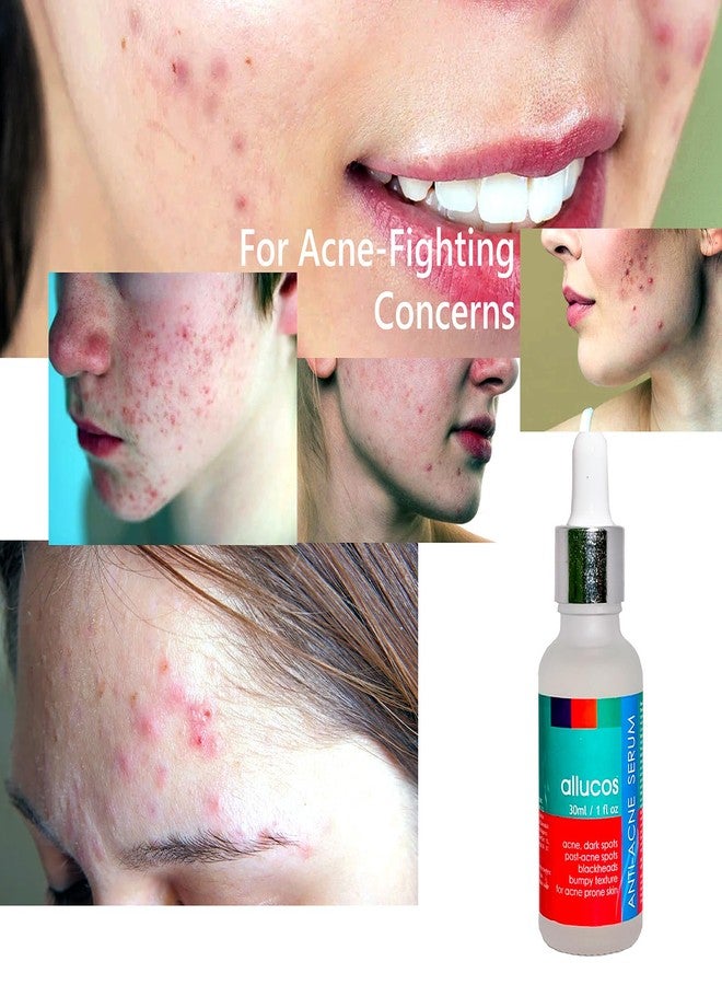ALLUCOS Anti-Acne Serum | 100% Natural & Paraben-Free | Reduces Pimples, Blemishes & Acne Scars | Controls Oil & Soothes Skin | Suitable for All Skin Types - For Men & Women - 30ml (Pack of 1) - Image 5