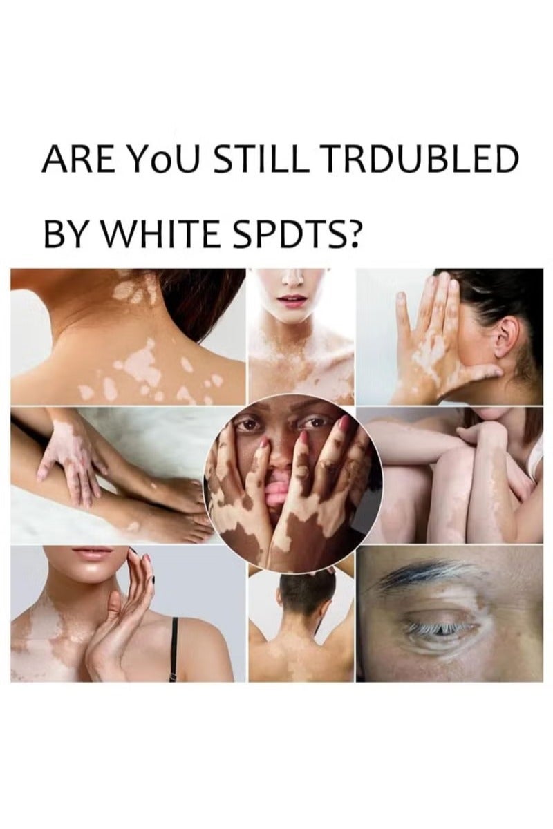 سوميفون كريم العناية بالبشرة فيتيليغو ، يقلل من البقع البيضاء ، وتحسين صبغة الجلد - Image 5