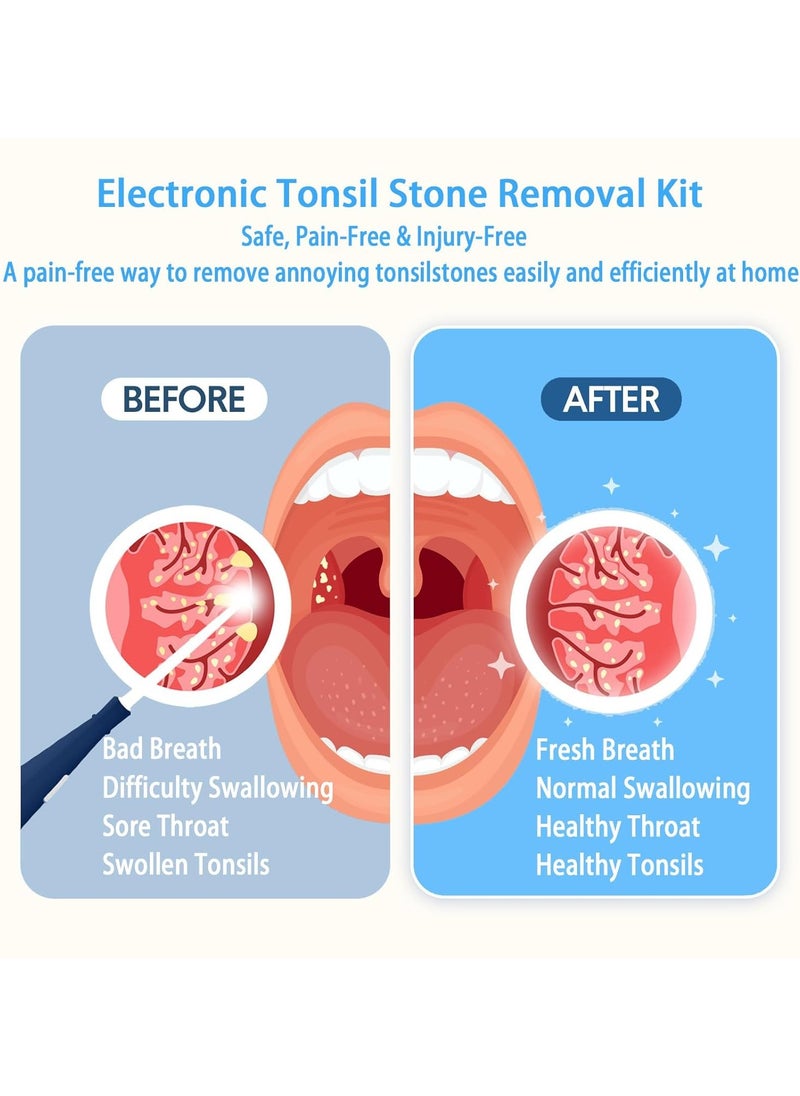 Ru syanl Electronic Vacuum Tonsil Stone Remover Fight Bad Breath Tonsil Stone Removal Tool with Suction 3 Suction Mode Fight Bad Breath Tonsil Stone  - Image 5