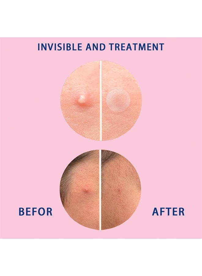 Acne Patches Absorbing Pimple Patches Invisible Spot Stickers Translucent Hydrocolloid Spot Patches, Facial Treatment, Fast Healing, Two Sizes(108 Patches)