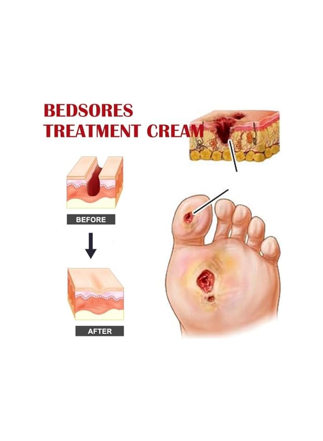 إيلهو كريم لعلاج ومنع قرح الضغط، مرهم عشبي لقرح الفراش، تخفيف للقرح من المرحلة 1 إلى 4، 20 جرام - Image 3