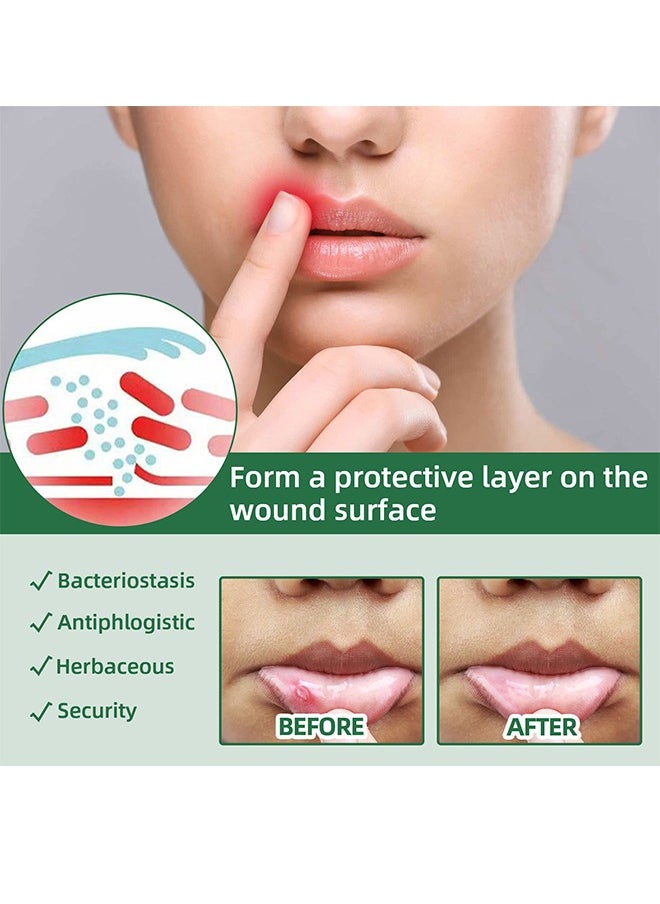 SOUTH MOON Canker Sore Treatment Spray ，Herbal Ulcer Treatment,Natural Mouth Sore Relief for Daily Oral Care, Mouth Spray,Treat Mouth Ulcer,Effective Mouth Sore Treatment-20ml  - Image 2