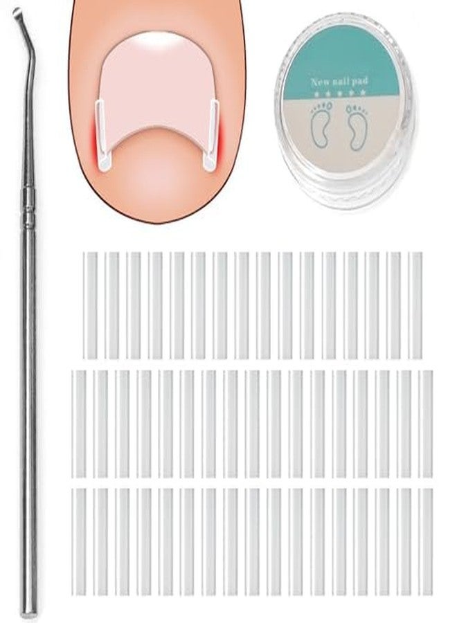 xinxingin 51 Pcs Toe Nail Corrector, Ingrown Nail Corrector Strips and Toenail Correction Tool, with Lifter, For Daily Foot Care Management and At-Home Treatments - Image 1