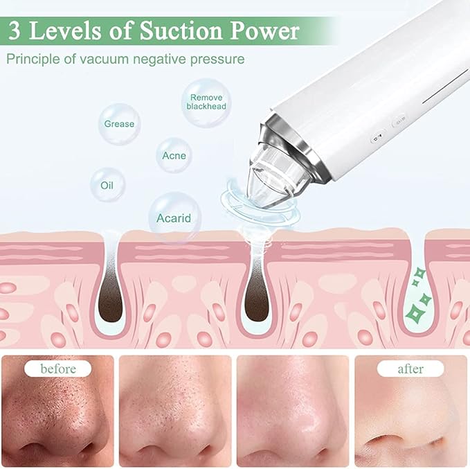 prabensei Blackhead Remover Pore Vacuum Upgraded WiFi Visible Facial Pore Cleanser with HD Camera Pimple Acne Comedone Extractor Kit with 6 Suction Heads USB Rechargeable Electric Black Head Suction Tool - Image 5