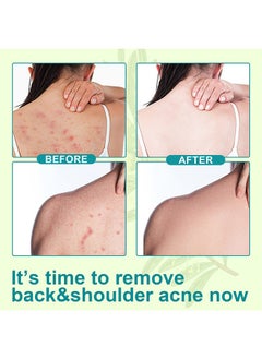 Elaimei Salicylic Acid Back Acne Treatment Spray，Tea Tree Oil Body Acne Treatment with Herbal Formula Back Acne Solution  Spray Soothing and Moisturizing 120ml  - Image 4
