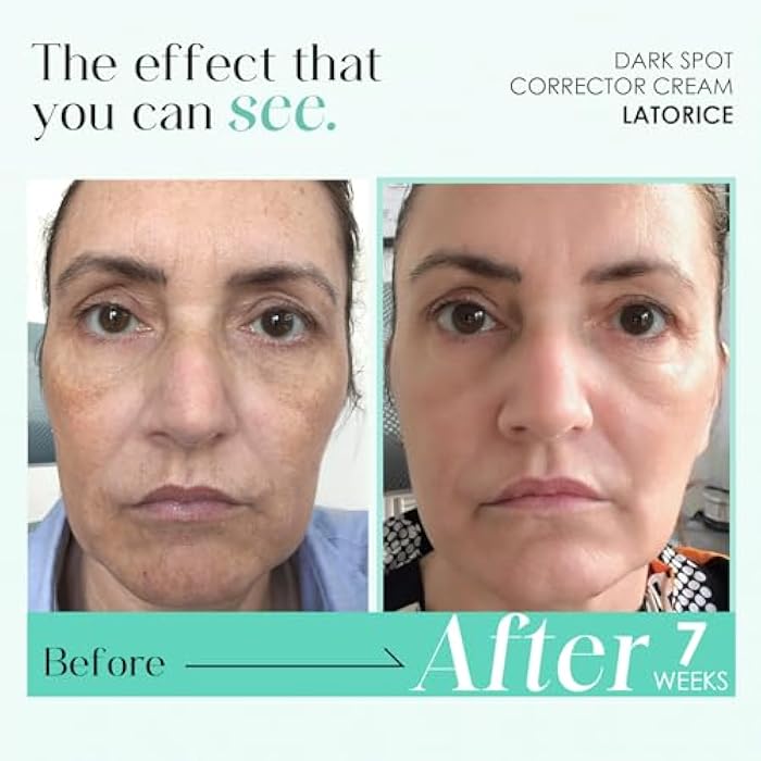 LATORICE Dark Spot Remover for Face and Body: Tranexamic Acid Serum for Women and Men - Reduce Sun Spot Melasma Freckles - Natural Ingredient Enriching Skin Care (1.7 Fl Oz) - Image 3