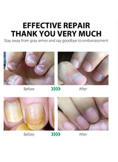 MOOYAM 7 DAYS Nail Fungus Treatment,Ginger Nail Treatment Nail Support Nail Care, , Ginger Nail Growth Serum, Ginger Cuticle Care Oil for Nails 30ml  - Image 3