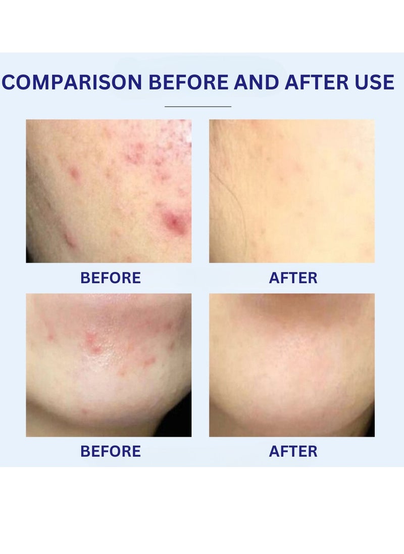 HEALMUSZ - Acne Removing Cream Natural Moisturizing Cream Acne Treatment Cream Skin Care and Cleansing Clear Face and Body Acne Blemish Cream for Acne and Blackheads Pimple Treatment Cream 20g - Image 1