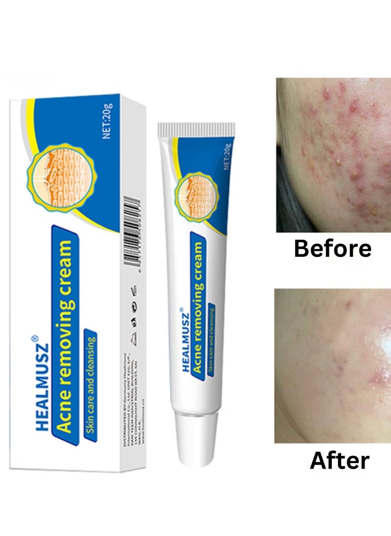 HEALMUSZ - Acne Removing Cream Natural Moisturizing Cream Acne Treatment Cream Skin Care and Cleansing Clear Face and Body Acne Blemish Cream for Acne and Blackheads Pimple Treatment Cream 20g - Image 1