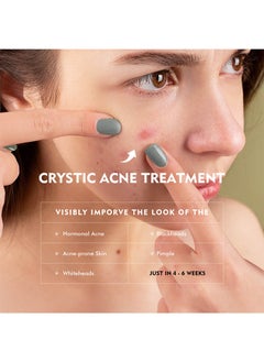 MOOYAM Acne Treatment Cream,Acne Spot Treatment gel,Clear Acne Spot Treatment Gel,Pimple Cream for Acne Prone Skin Care,Acne Control Gel,Salicylic Acid Acne Treatment Gel,Clear Breakouts, 30g  - Image 3