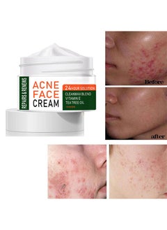 علاج حب الشباب علاج الوجه كريم حب الشباب علاج حب الشباب الطبيعي علاج حب الشباب الكيس, For All Skin Types, Premium Acne Scar كريم & Pimple Remover -30ML. - pzsku/Z362930EC736764E687ADZ/45/_/1689212059/83c62bf9-7998-4764-bd97-29ab1626ade2