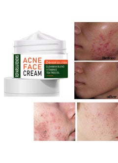 MOOYAM Acne Treatment Face Cream, Acne Spot Treatment for Face & Acne Dots, Natural Cystic Acne Treatment, For All Skin Types, Premium Acne Scar Cream & Pimple Remover - 30ML  - Image 1