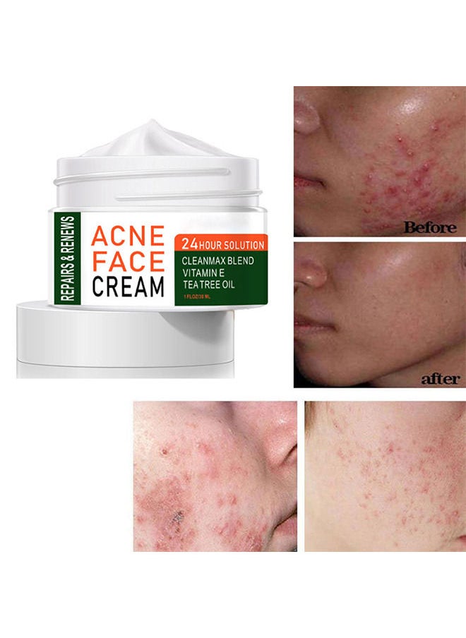 MOOYAM Acne Treatment Face Cream, Acne Spot Treatment for Face & Acne Dots, Natural Cystic Acne Treatment, For All Skin Types, Premium Acne Scar Cream & Pimple Remover - 30ML  - Image 1