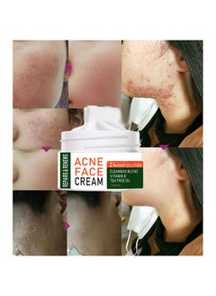 MOOYAM Acne Treatment Face Cream, Acne Spot Treatment for Face & Acne Dots, Natural Cystic Acne Treatment, For All Skin Types, Premium Acne Scar Cream & Pimple Remover - 30ML  - Image 5
