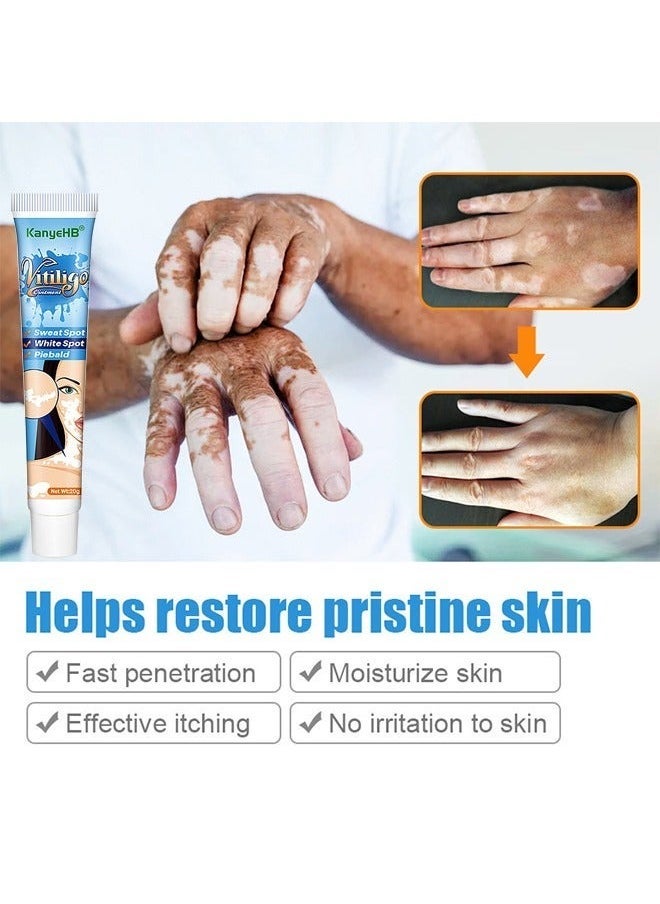 KanyeHB - Vitiligo Ointment, Vitiligo Treatment For Skin Vitiligo, Vitiligo Care Cream For Reduce White Spots And Improve Skin Pigmentation 20G - Image 1